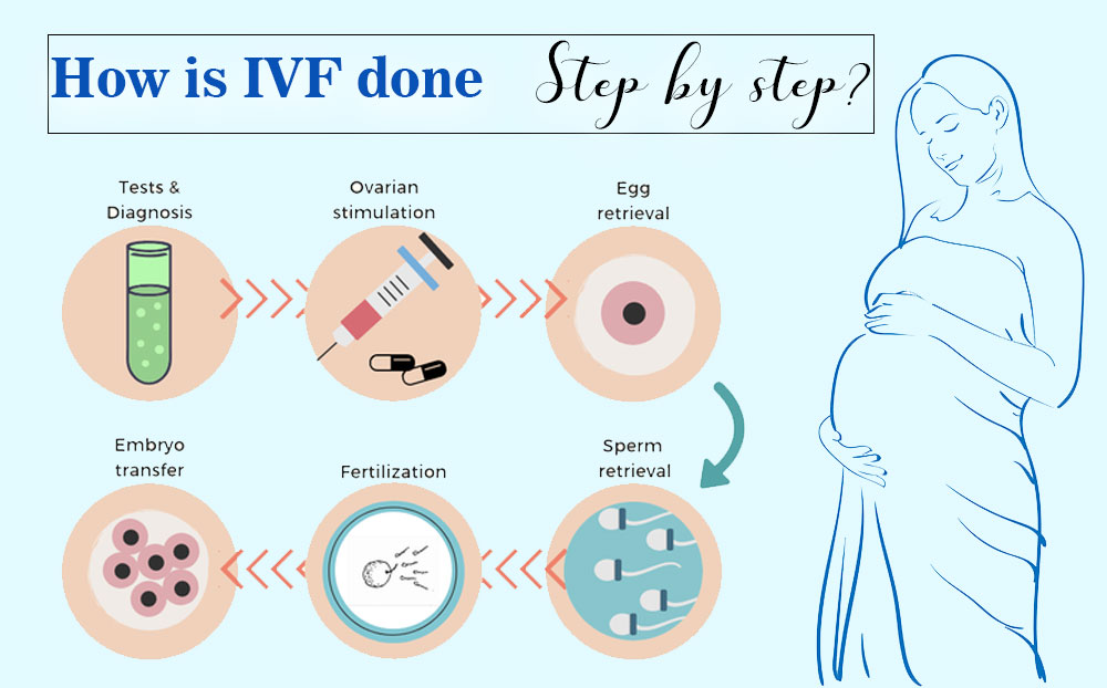 IVF Step-by-Step Process- Infertile Couples must be Aware Of