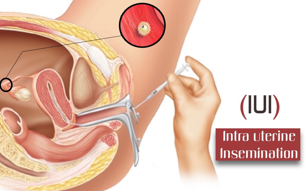 IUI---Intrauterine Insemination the Right Fertility Procedure For You